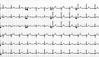 Normal-EKG einer herzgesunden jungen Frau