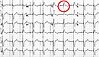 Schrittmacher-EKG