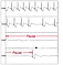 Automatisch aufgezeichnetes EKG bei einem Patienten mit Synkopen