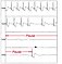 Automatisch aufgezeichnetes EKG bei einem Patienten mit Synkopen