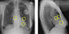 Röntgenbild eines Thorax mit implantiertem CRT-P System (sog 