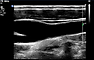 Karotis-Ultraschall: Normalbefund (B-Mode)