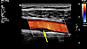 Karotis-Ultraschall: Plaque in der art. carotis communis